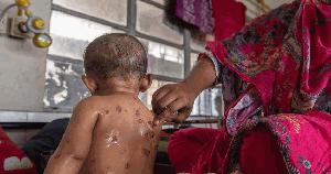 Measles claims 4 more children's lives in 24hrs